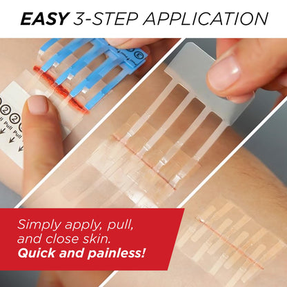 Clozex Emergency Laceration Closure Only- Close Wounds Without Stitches with This Surgical-Grade Skin Device. Available in 3 Variations for Wounds up to 1.0” or 3.5”. Life Happens, Be Ready!